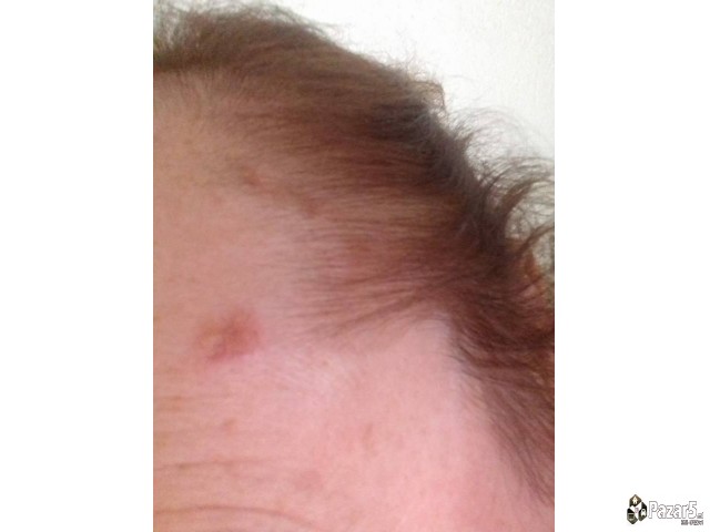 Lek Za Bradavici I Mladezi