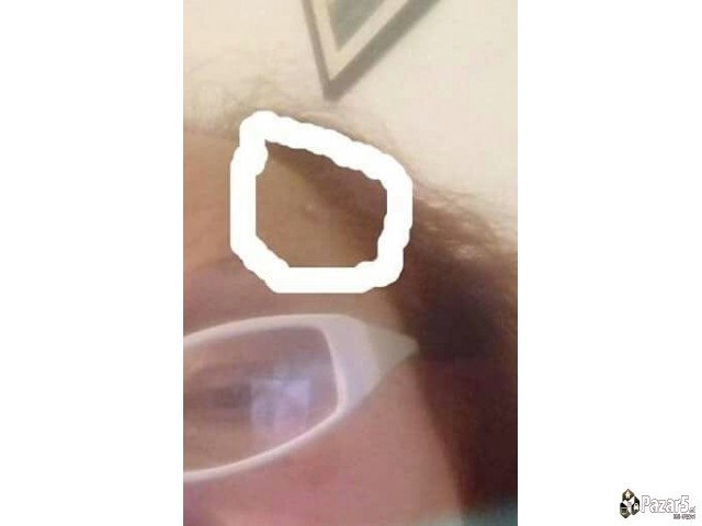 LEK ZA BRADAVICI I MLADEZI