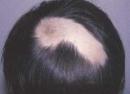 Лекување од Косопас (alopecia Areata)