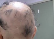 Лекување од Косопас (alopecia Areata)
