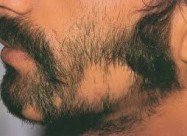 Лекување од Косопас (alopecia Areata)
