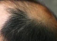 Лекување од Косопас (alopecia Areata)