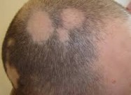 Лекување од Косопас (alopecia Areata)