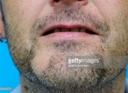 Лекување од Косопас (alopecia Areata)