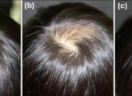 Лекување од Косопас (alopecia Areata)
